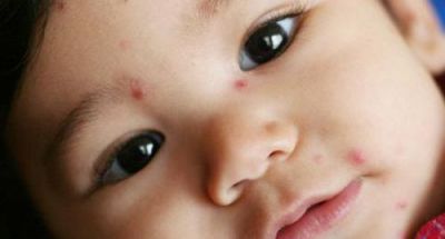 Nguyên nhân, biểu hiện và cách phòng chống bệnh thủy đậu ở trẻ em